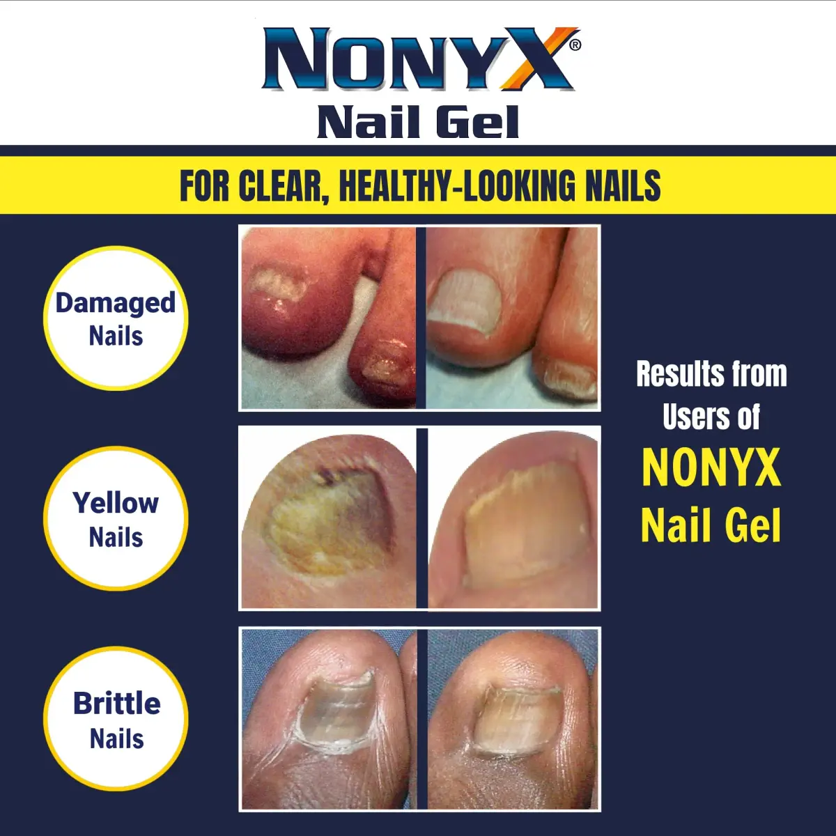 NONYX Fungal Nail Clarifying Gel 118ml (4 Fl Oz) | Clinically Proven to Improve Nail Appearance - view 5