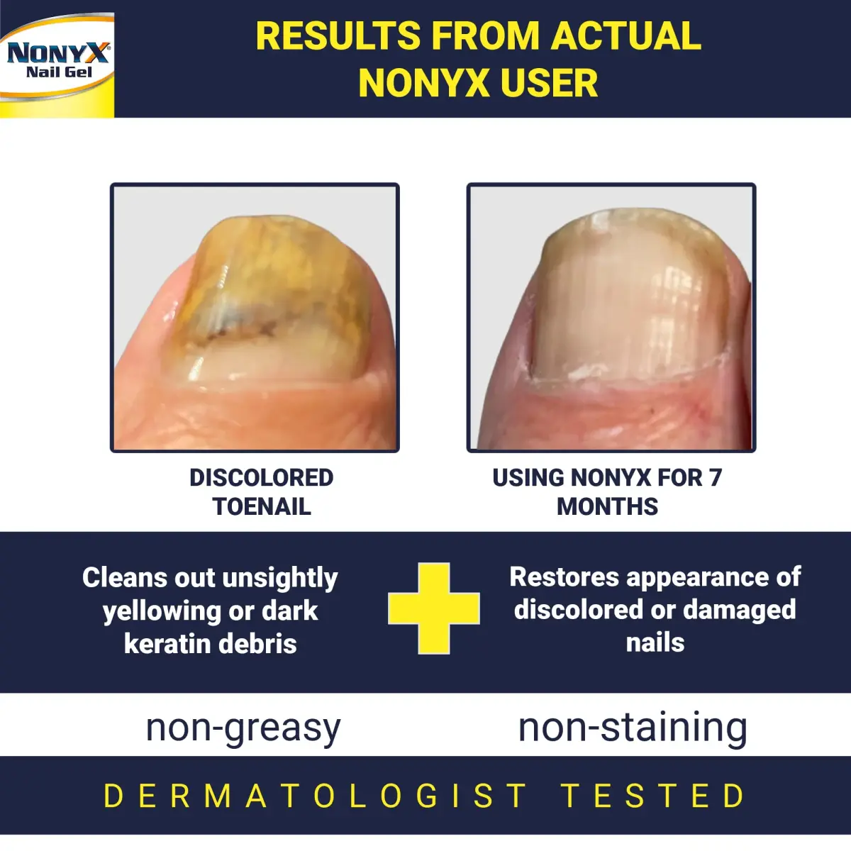 NONYX Fungal Nail Clarifying Gel 118ml (4 Fl Oz) | Clinically Proven to Improve Nail Appearance - view 2