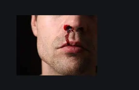 NasalCEASE FirstAid Nosebleeds | Natural Clotting Aid for All Ages in India - view 4