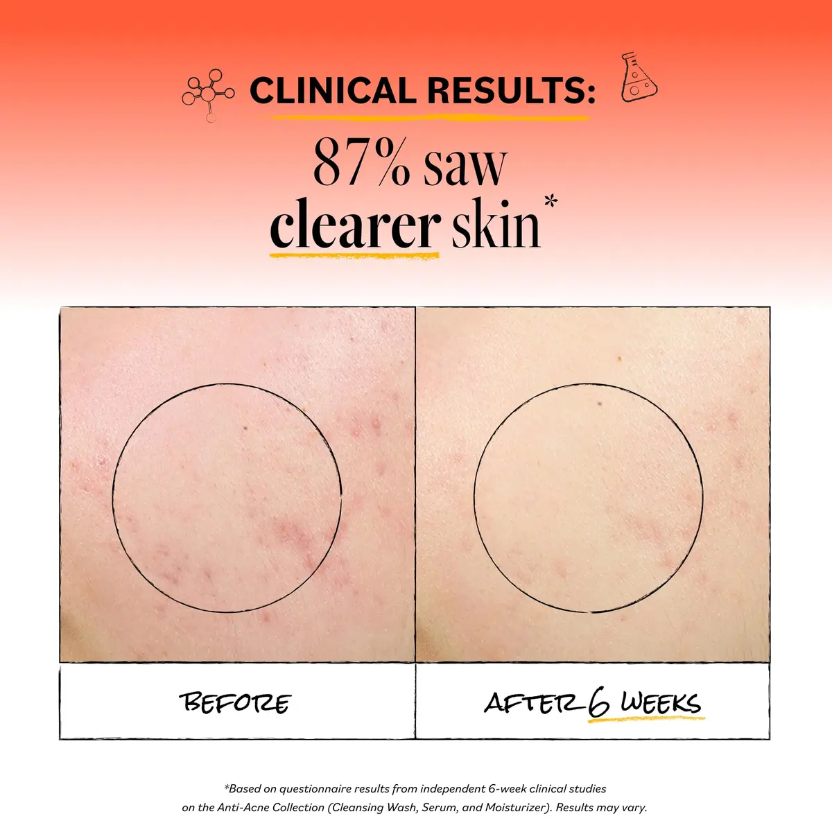 Derma E Acne Deep Pore Cleansing Face Wash 177ml (6 Fl Oz) | Gentle Oil Control for Breakout-Prone Skin - view 3