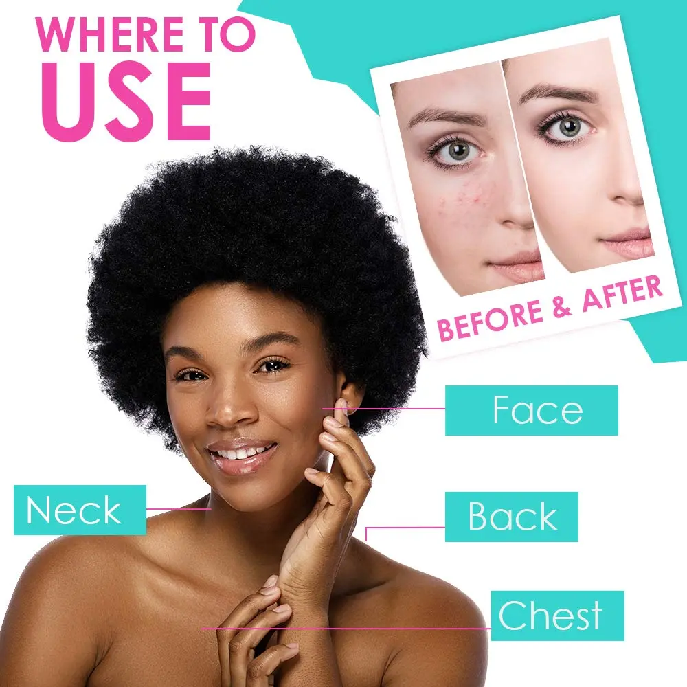 Bye Bye Blemish Acne Drying Lotion 1oz | Reduce Pimples Overnight for Sensitive Skin - view 5