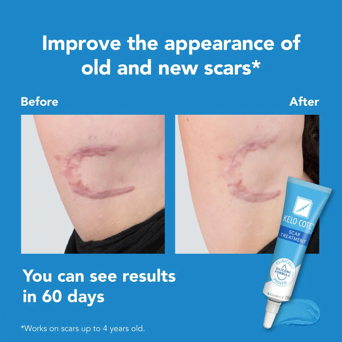 KELO-COTE Silicone Scar Gel 6g | Waterproof, Softens & Flatten Hypertrophic & Keloid Scars - view 5