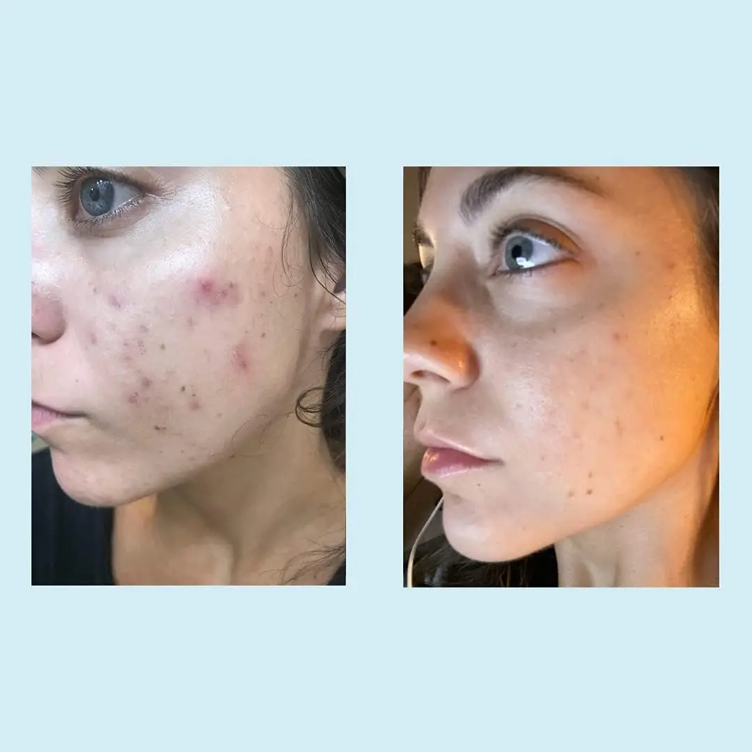 Perfect Image Glycolic Acid 30% Gel Peel with Retinol & Green Tea, 30mL | Professional Chemical Exfoliant for All Skin Types - view 5