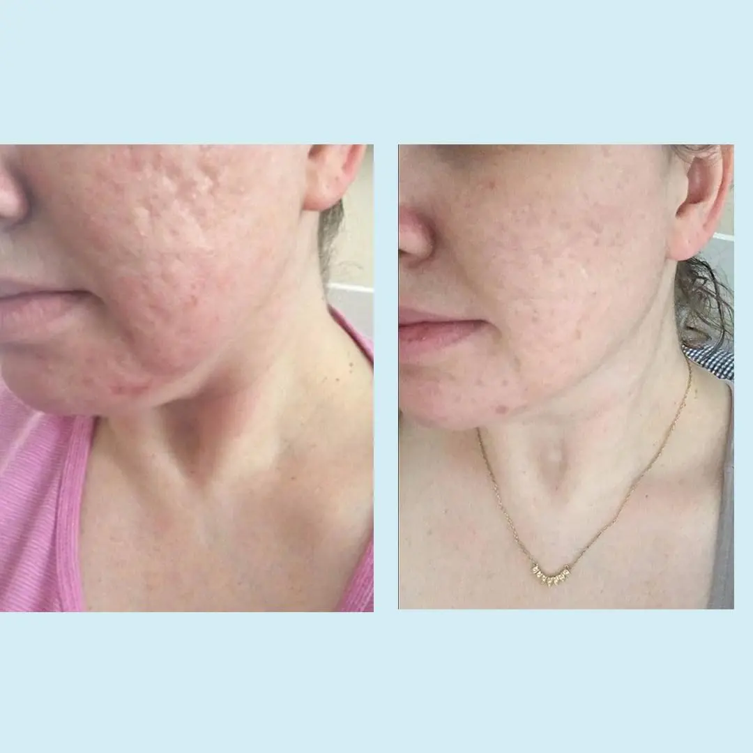 Perfect Image Glycolic Acid 30% Gel Peel with Retinol & Green Tea, 30mL | Professional Chemical Exfoliant for All Skin Types - view 6