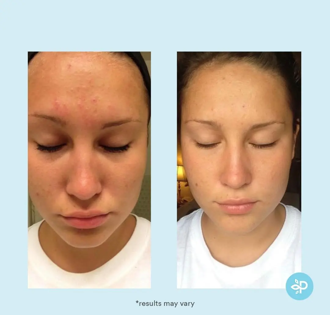 Perfect Image Glycolic Acid 30% Gel Peel with Retinol & Green Tea, 30mL | Professional Chemical Exfoliant for All Skin Types - view 4