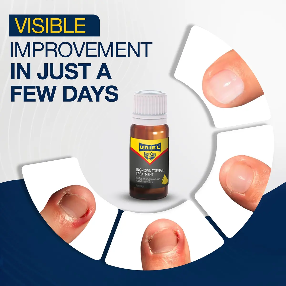 URIEL Ingrown Toenail Treatment 11 ml | Supports Nail Health & Comfort for Home Use - view 2