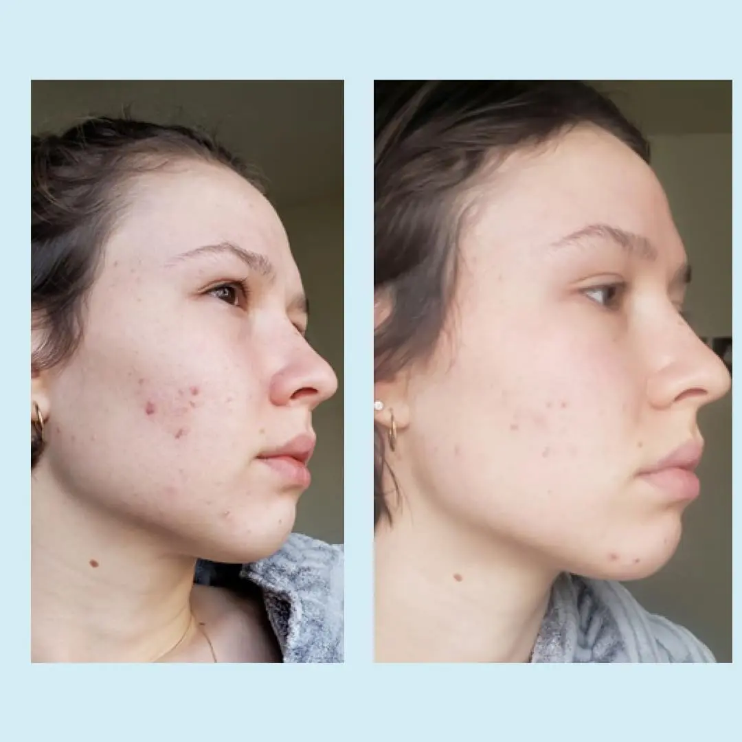 Perfect Image Glycolic Acid 50% Gel Peel with Retinol & Green Tea, 30ml | Professional Skin Exfoliant for Dry Skin - view 6