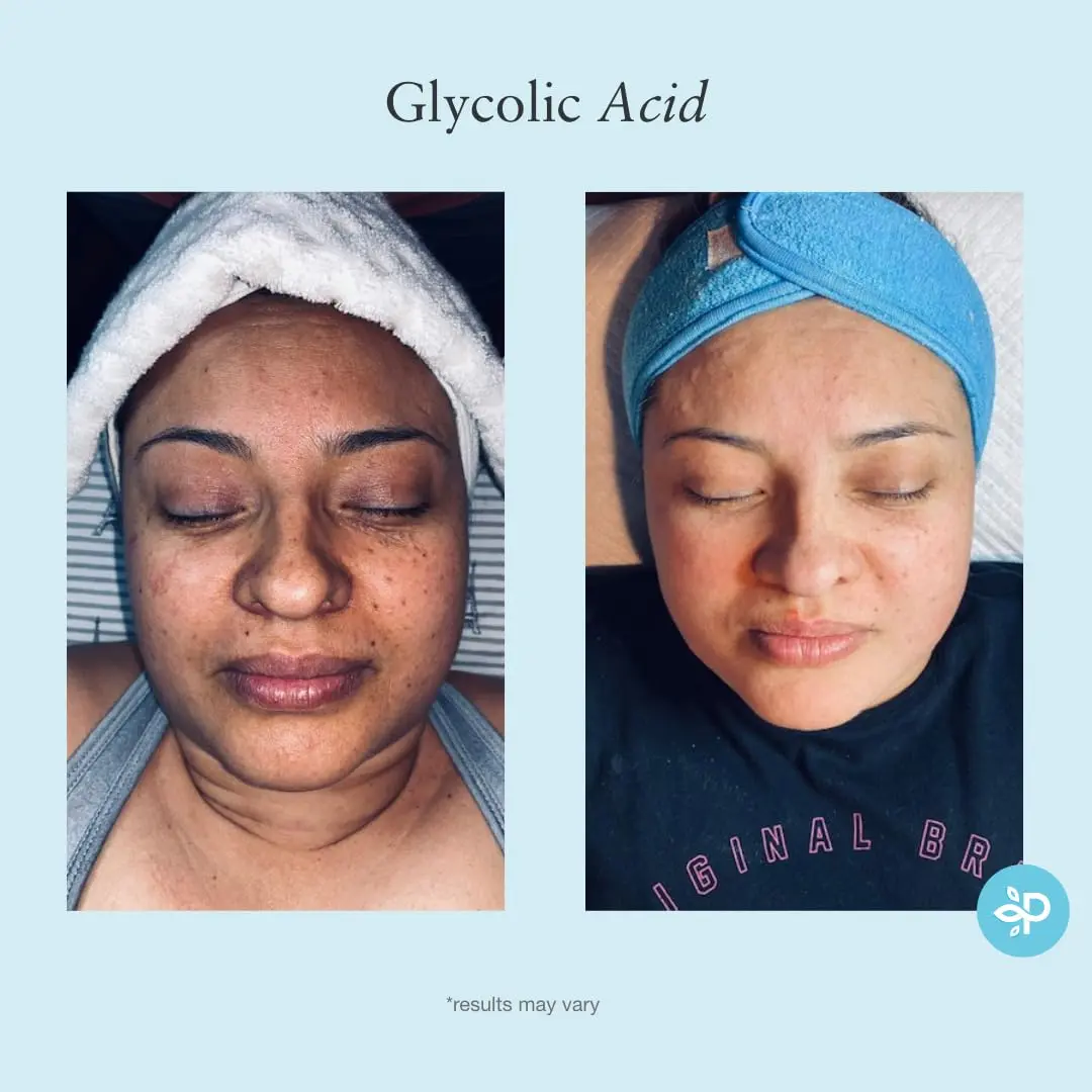 Perfect Image Glycolic Acid 50% Gel Peel with Retinol & Green Tea, 30ml | Professional Skin Exfoliant for Dry Skin - view 7