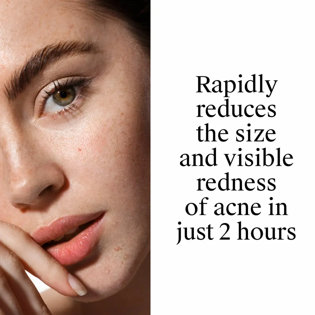 Neutrogena Rapid Clear Stubborn Acne Spot Treatment Gel 1 oz | Maximum Strength 10% Benzoyl Peroxide for Acne Prone Skin - view 6