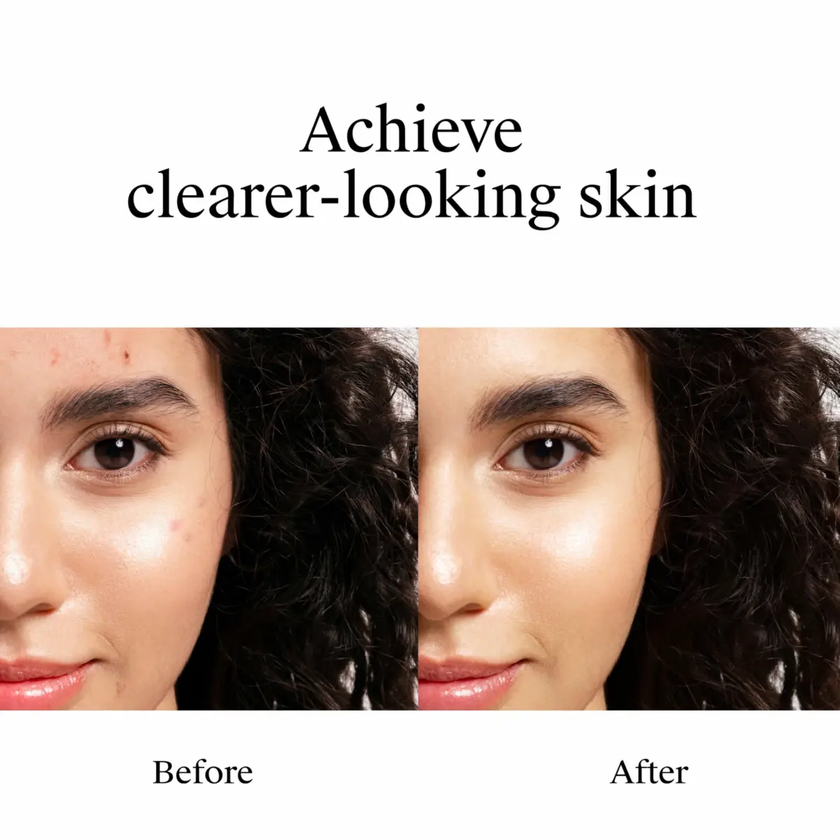 Neutrogena Rapid Clear Stubborn Acne Spot Treatment Gel 1 oz | Maximum Strength 10% Benzoyl Peroxide for Acne Prone Skin - view 3