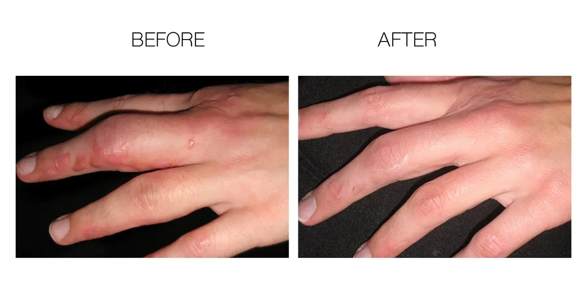 ScarFade Silicone Scar Gel for Scar Removal & Therapy - 30g | Clinically Tested, Non-Irritating, Unscented - view 2