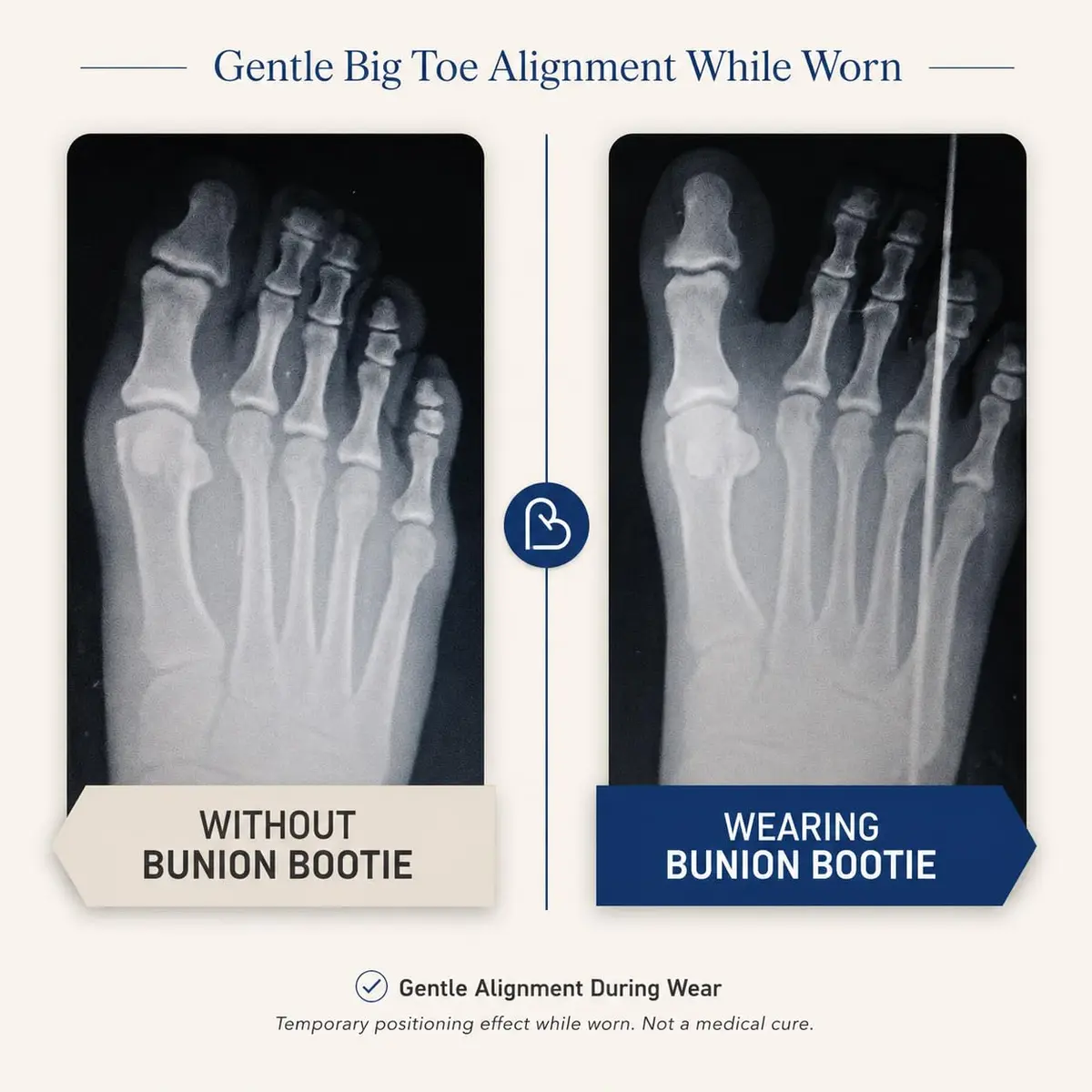 Bunion Bootie Big Toe Corrector Sleeve for Women & Men | Ultra-Thin, Breathable, Non-Surgical Support - view 4