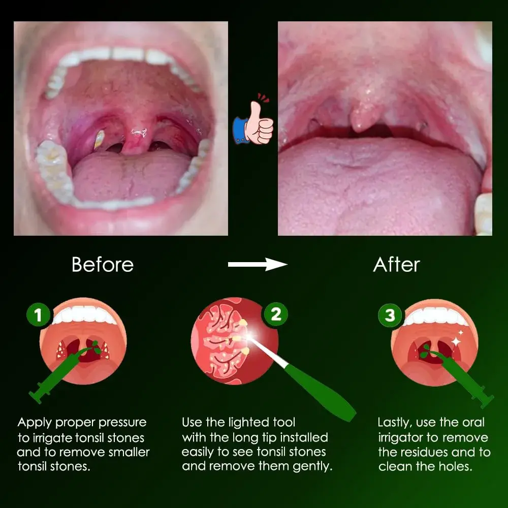 airgoesin Upgraded Tonsil Stone Remover Tool with 5 Tips & Irrigator | Fresh Breath Oral Rinse - view 6