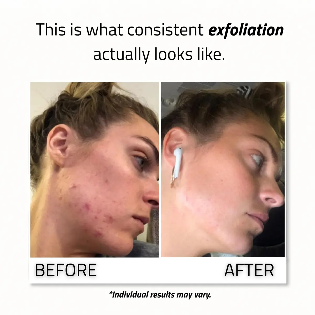 YEOUTH Glycolic Acid Face Peel 30% with Retinol & Green Tea 1oz | Brightening & Exfoliating - view 4