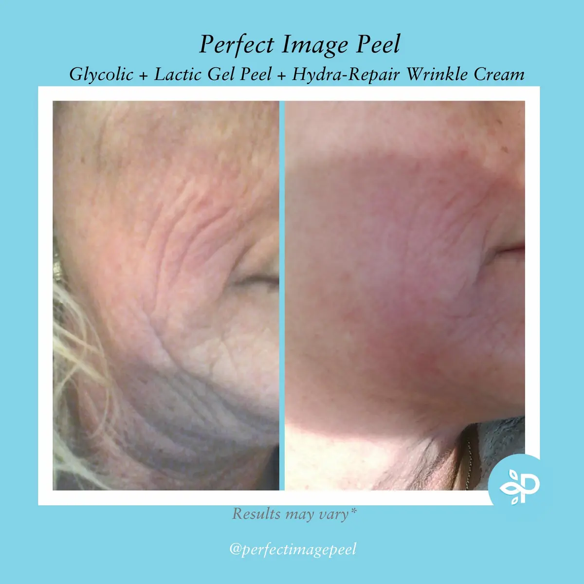 Perfect Image Glycolic Gel Peel 10% Strength | Exfoliating & Hydrating Skin Treatment - view 5