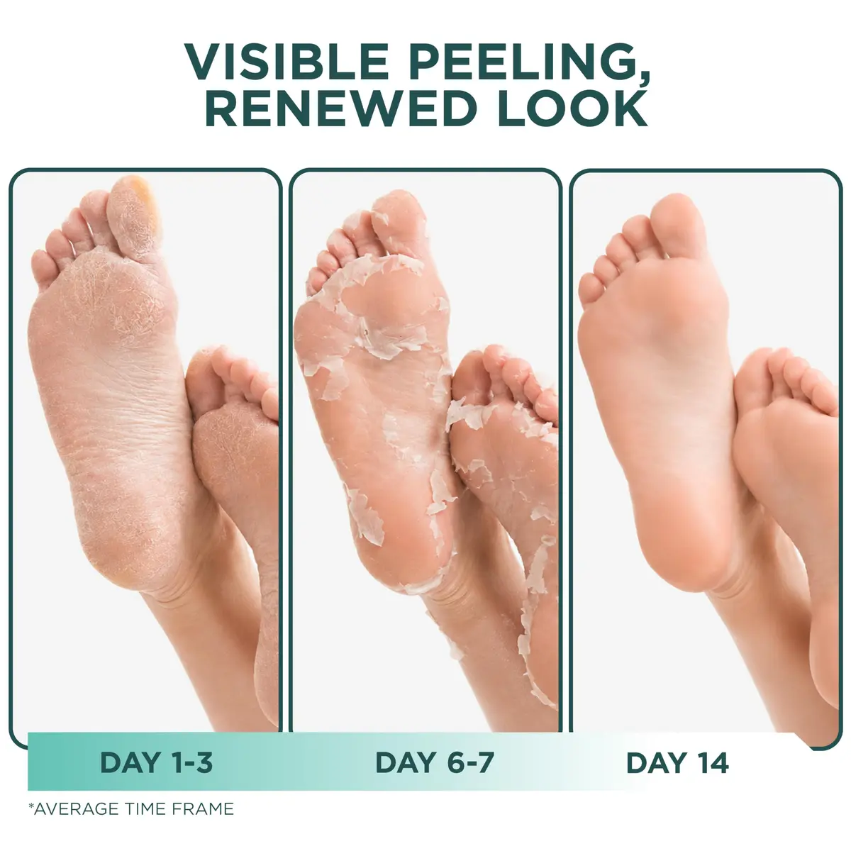 DERMORA Foot Peel Mask, Exfoliating Foot Peeling Mask, 2 Pairs, Original | Gentle Dead Skin Removal for Dry Feet - view 3