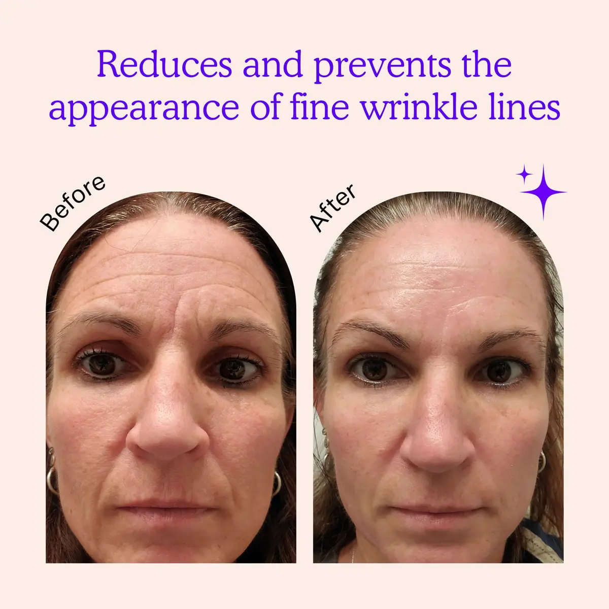 BLUMBODY Wrinkle Patches for Face, Forehead, Smile Lines & Eyes 165 pcs | Reusable Silicone Anti-Wrinkle Patches - view 2