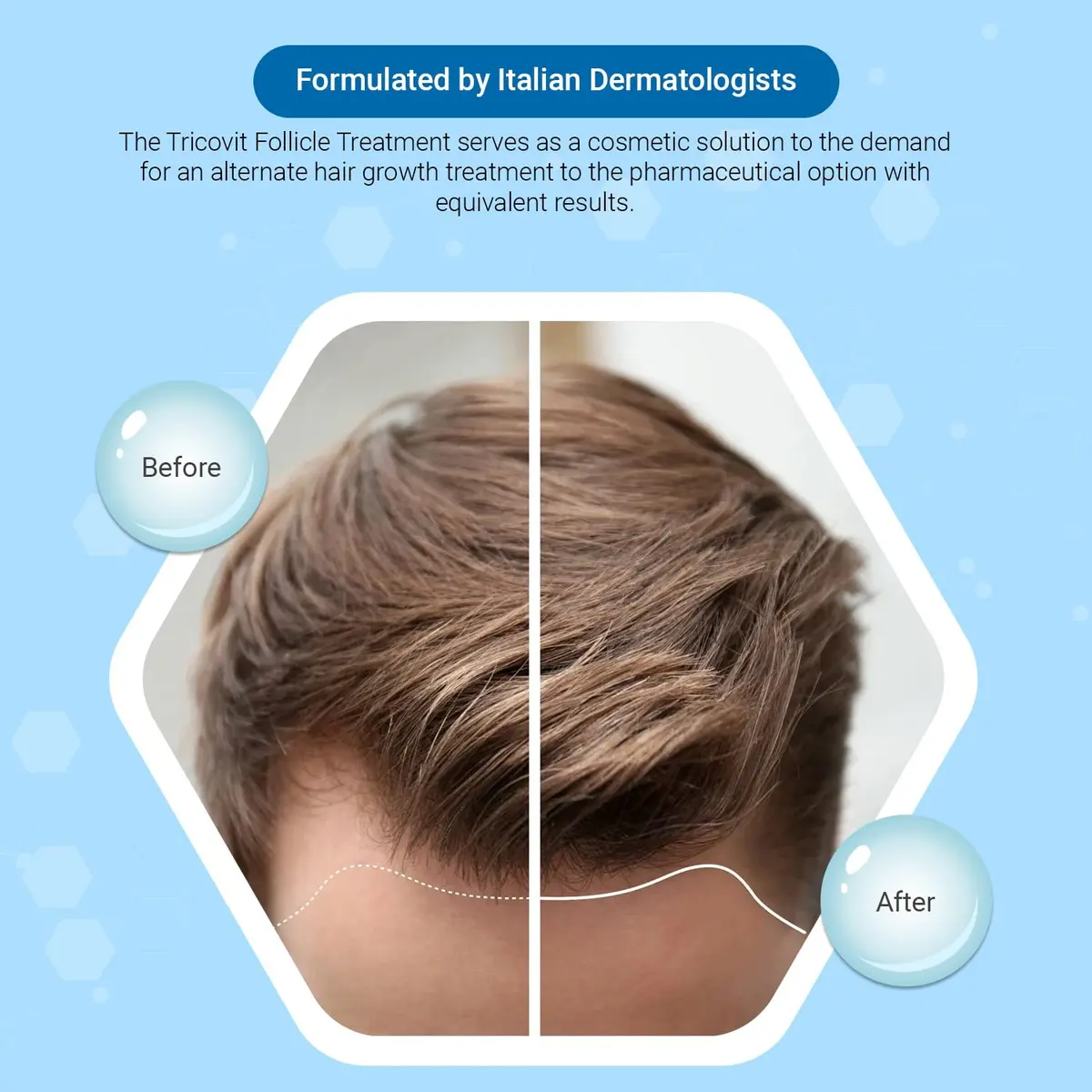 Tricovit Forte Hair Loss Treatment - Hair Growth Products for Women & Men - Sebum Regulator (2.7 Fl Oz) - view 2