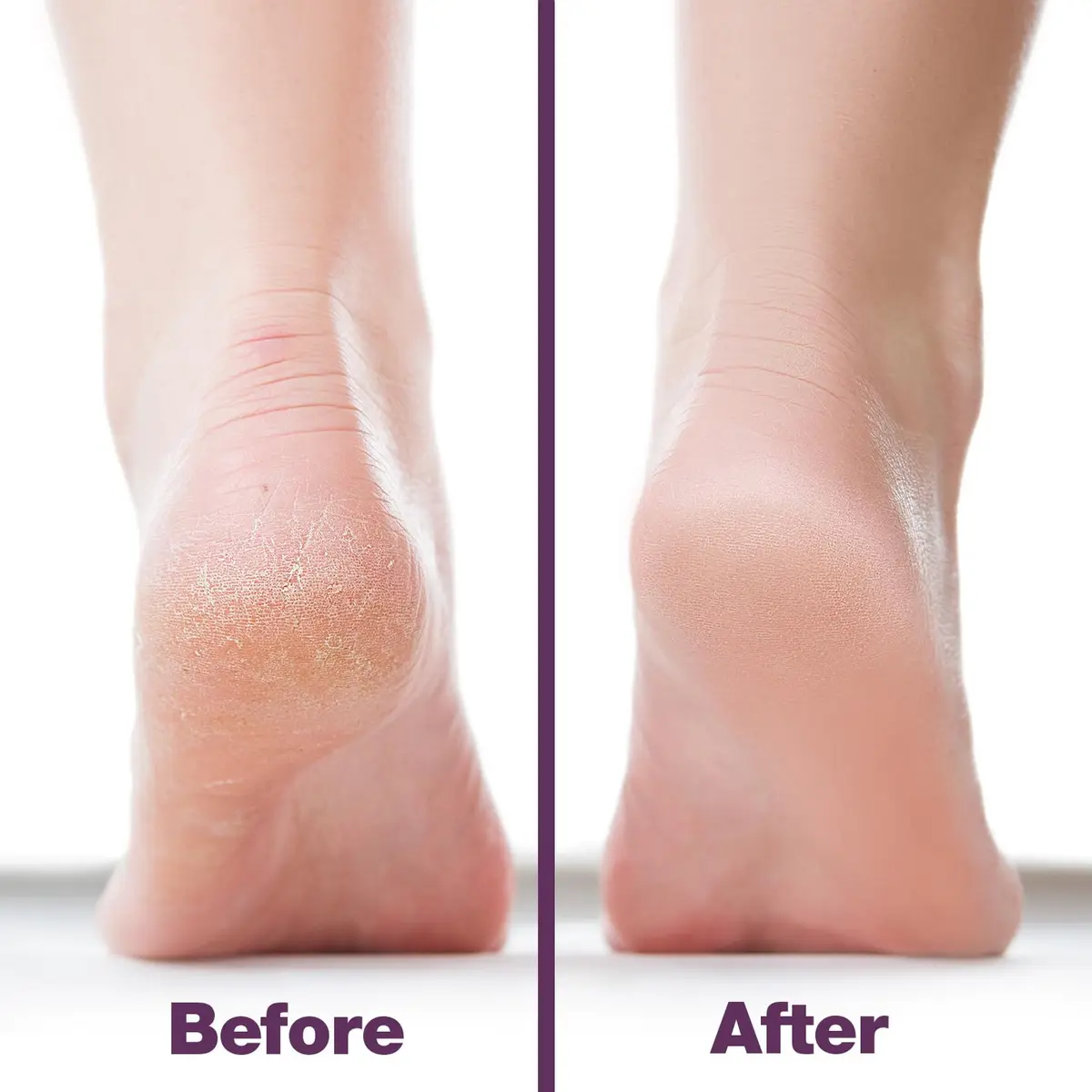 Probelle Double Sided Nickel Foot File Callus Remover, Purple | Safe, Hypoallergenic Pedicure Tool for Dry Feet - view 4
