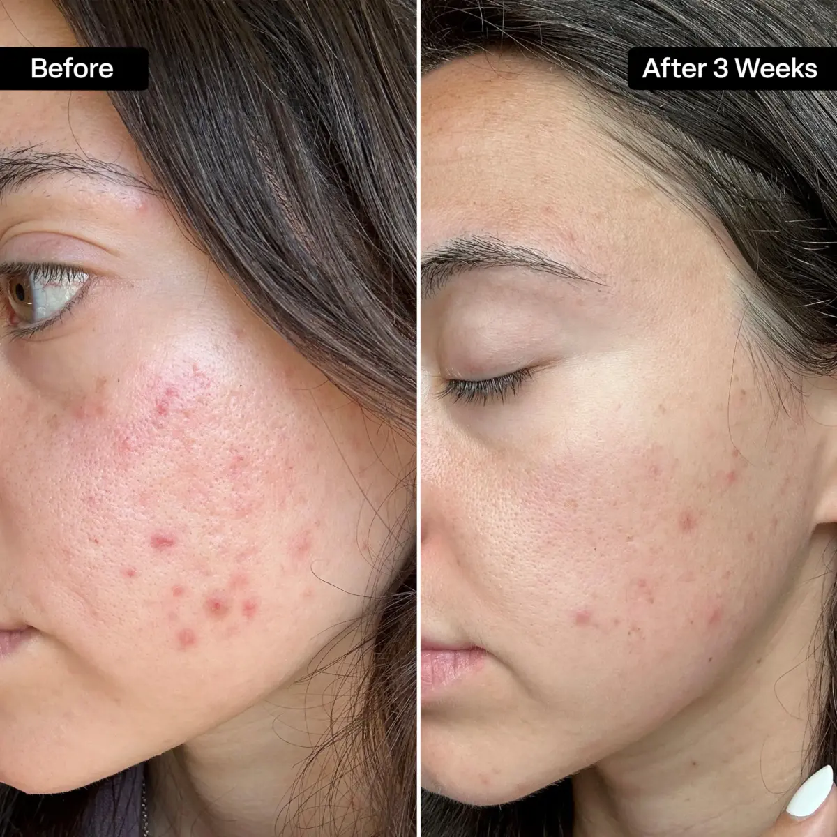 QRxLabs Salicylic & Glycolic Acid Acne Clearing Pads 50ct | Dual-Action Exfoliation for All Skin Types - view 3