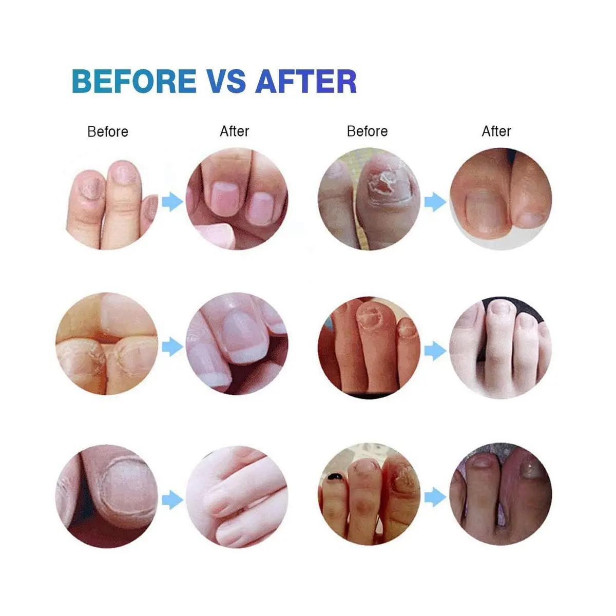 Ariella Toenail Fungus Treatment Extra Strength 12ml | Fungal Nail Repair Pen 4 Pack - view 4