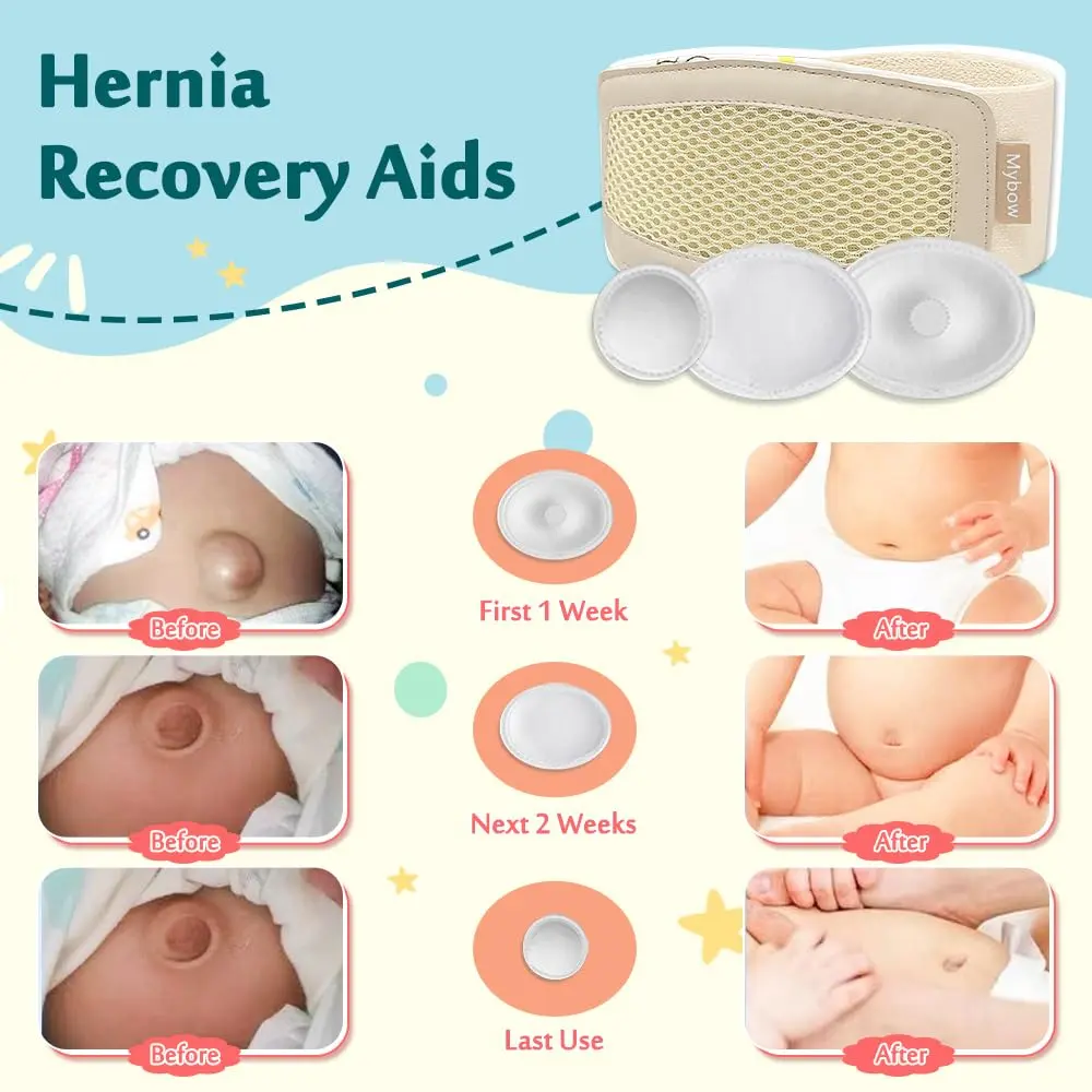 Mybow Umbilical Hernia Belt Baby | Gentle Support for Newborns (70-120 chars) - view 3