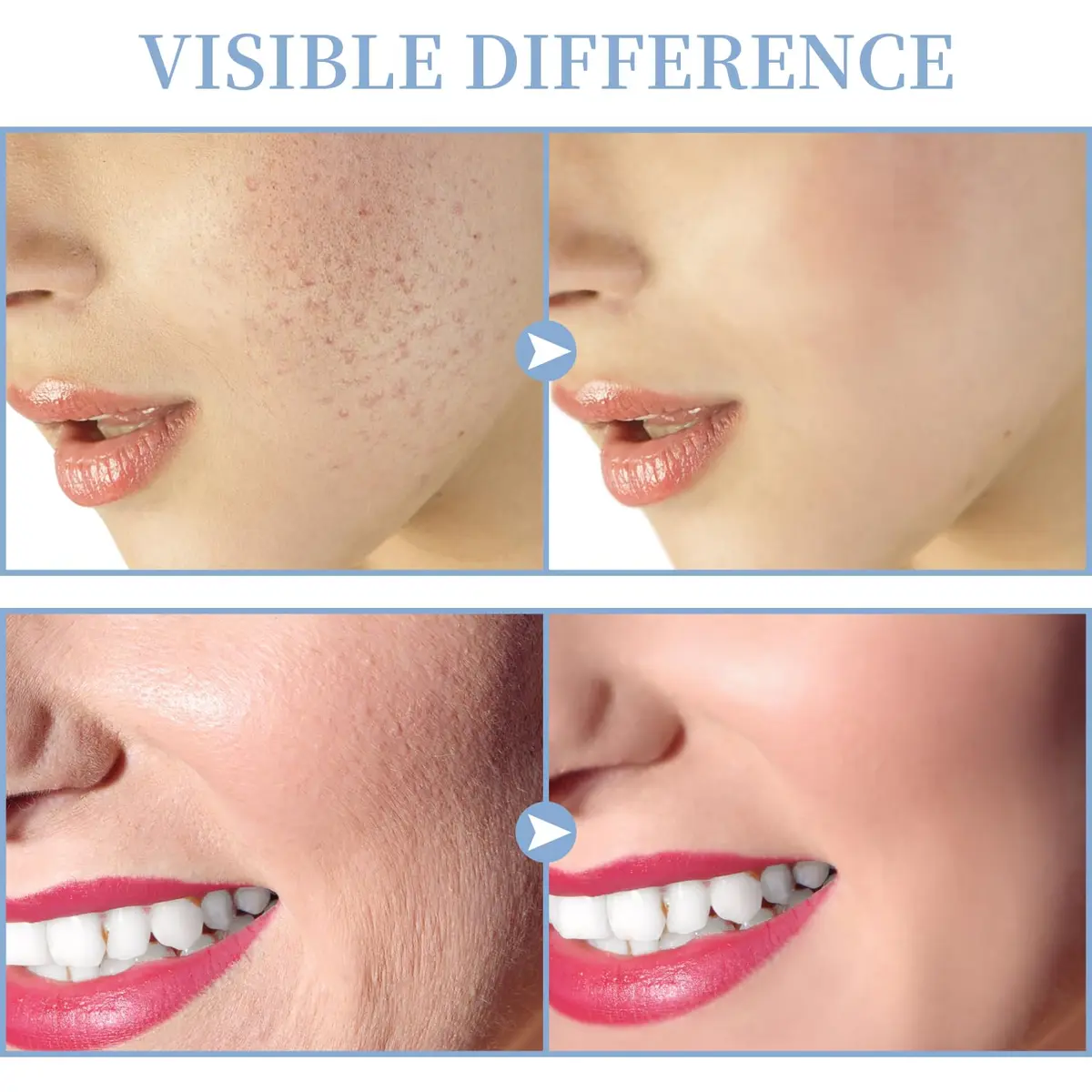 TUMAKOU High Frequency Facial Machine 14PCS | Portable Handheld Skin Therapy Device - view 4