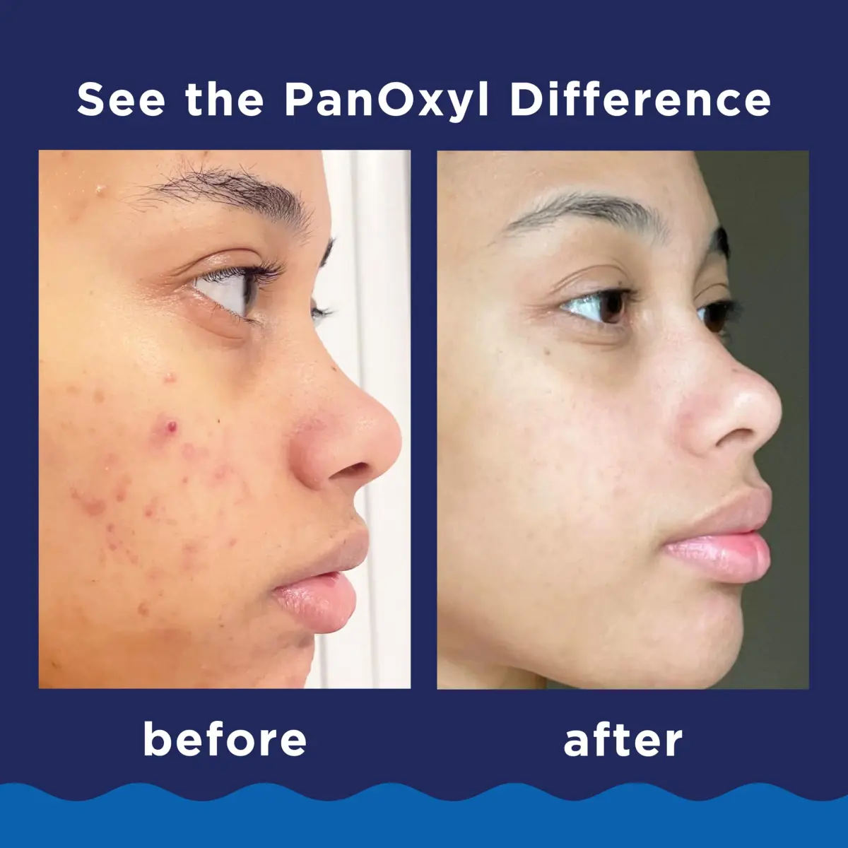 PanOxyl 10% Benzoyl Peroxide Acne Foaming Wash 156g (5.5 Oz) | Maximum Strength Daily Face and Body Cleanser - view 4