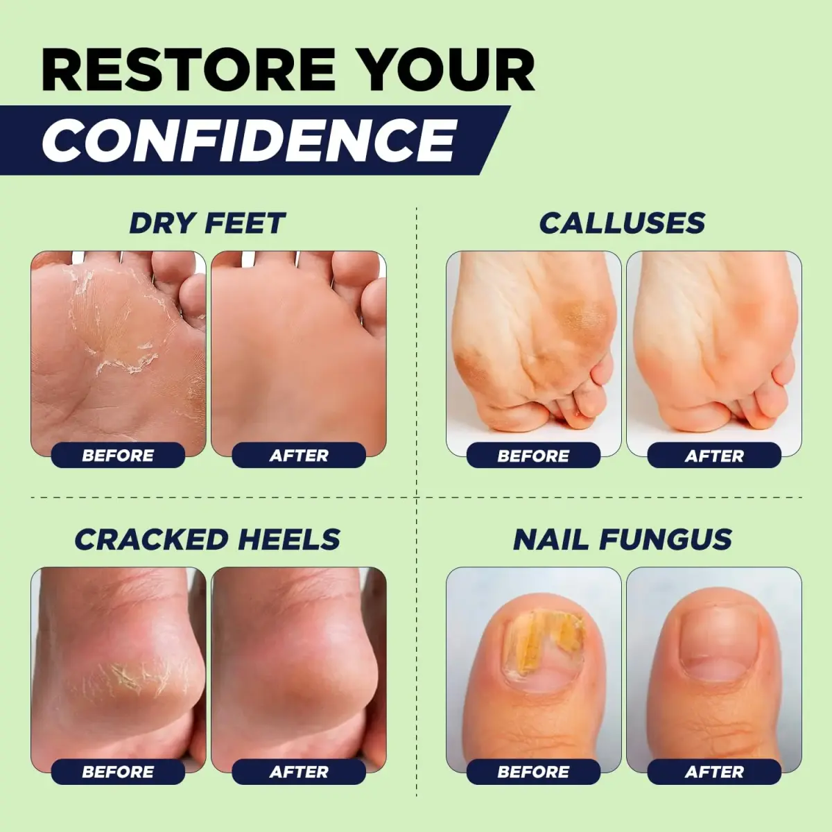 FOOT CURE Tea Tree Oil Epsom Salt Foot Soak 473ml (16 Fl Oz) | Softens Calluses & Refreshes Tired Feet - view 5