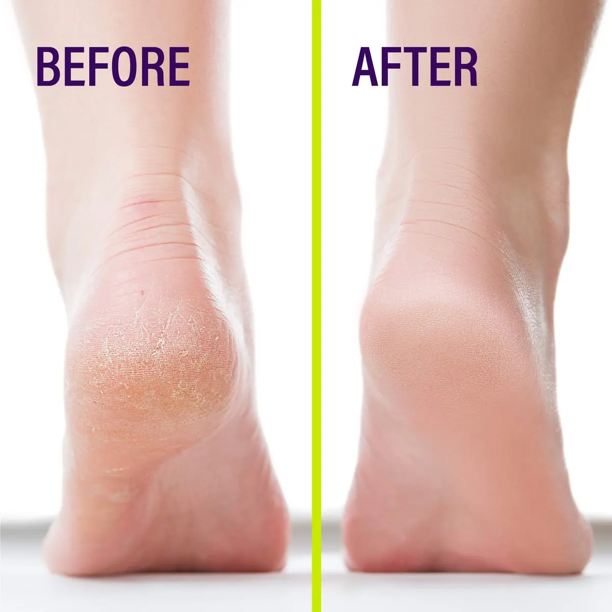 Heel-Seal Liquid Skin Protectant for Cracked Heels 14g (0.5 Oz) | Seals & Repairs Cracked Feet - view 6