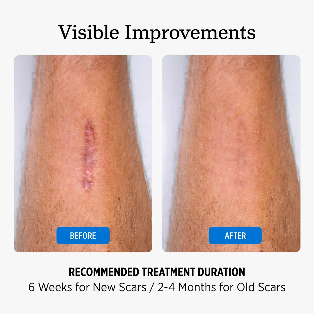 NUVADERMIS Silicone Scar Sheets for Surgical & Old Scars | Hydrating, Comfortable & Dermatologist Tested - view 5