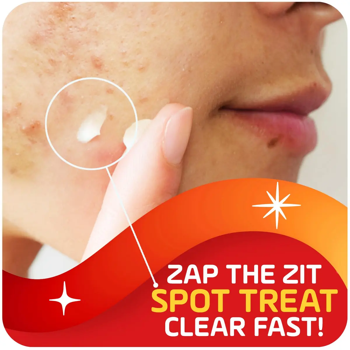 Asepxia 2% Salicylic Acid Acne Spot Treatment Cream | Targets Blemishes & Redness, 1 Oz, 3-Pack - view 2