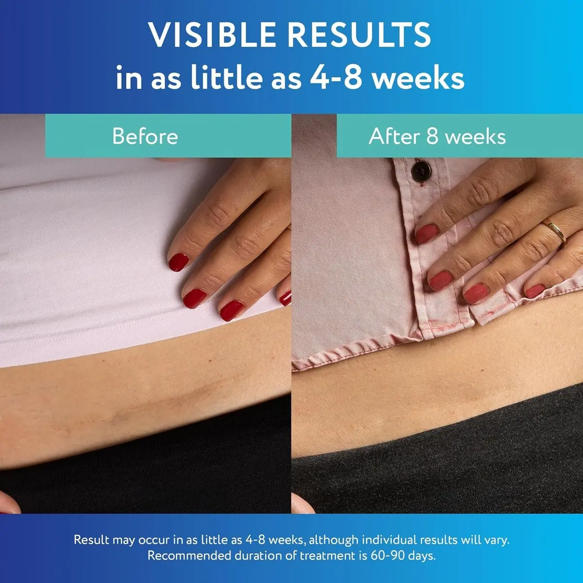 ScarAway Advanced Clear Silicone Scar Sheets, 6 Sheets | Visibly Improve Old & New Scars - view 4