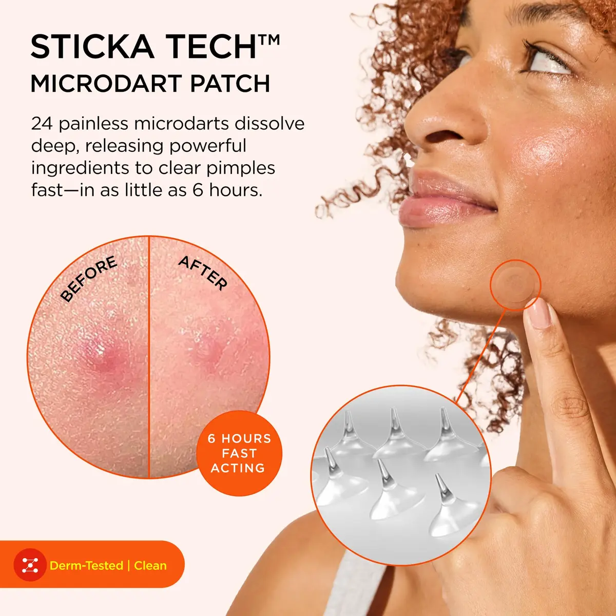 ZitSticka Killa Kit Microdart Pimple Patch for Face, 20 Count | Fast-Acting, Target Emerging Pimples - view 2