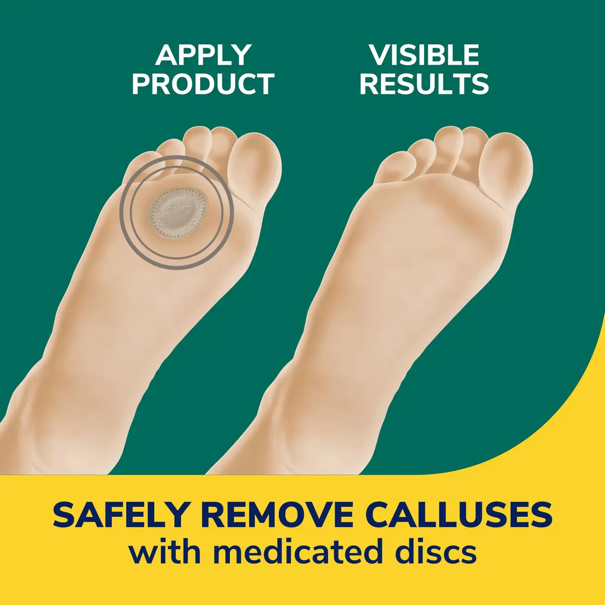Dr. Scholl's Extra Thick Callus Remover Discs 4 Count | Medicated Pads for Softening Hard Calluses and All-Day Pain Relief - view 3