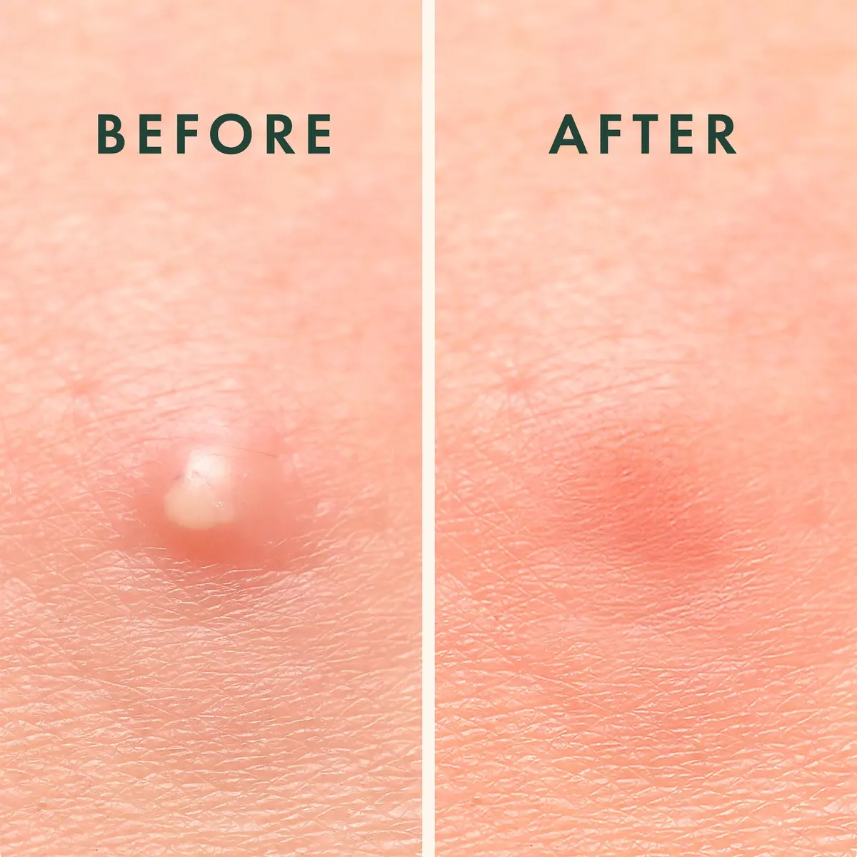 Rael Hydrocolloid Acne Pimple Patches 52 Ct | Overnight Spot Cover for All Skin Types - view 7