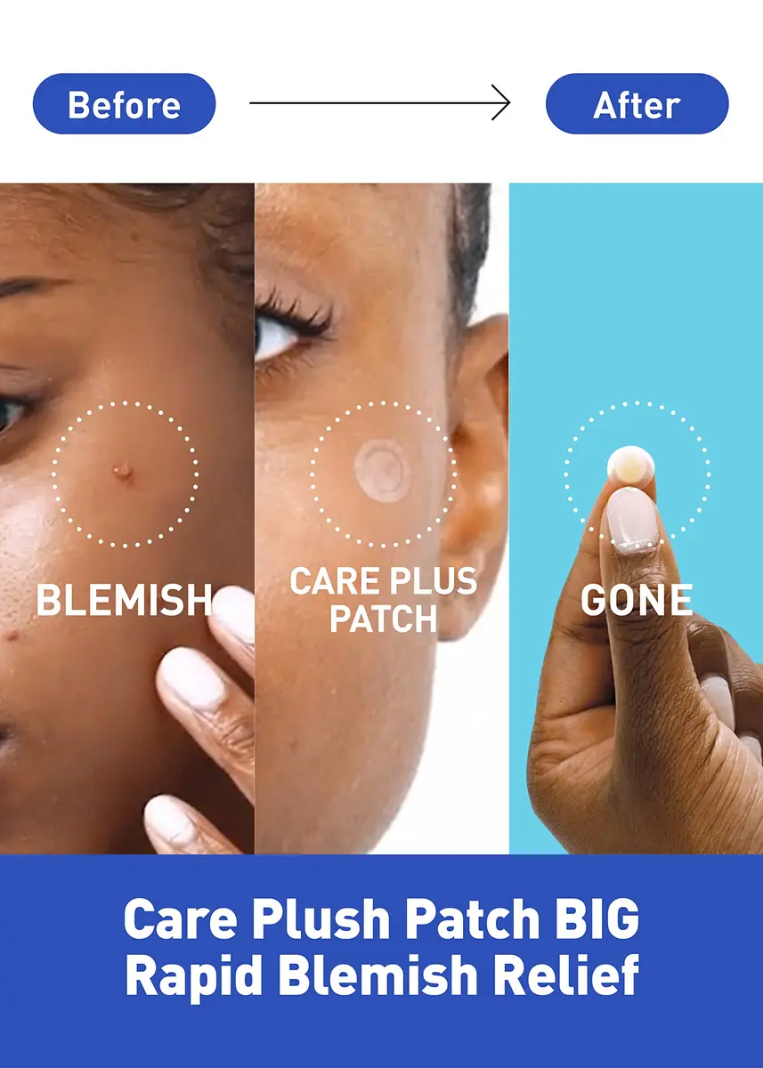 OLIVE YOUNG Hydrocolloid Spot Patch Big 81 Count | Acne & Pimple Treatment for All Skin Types - view 2