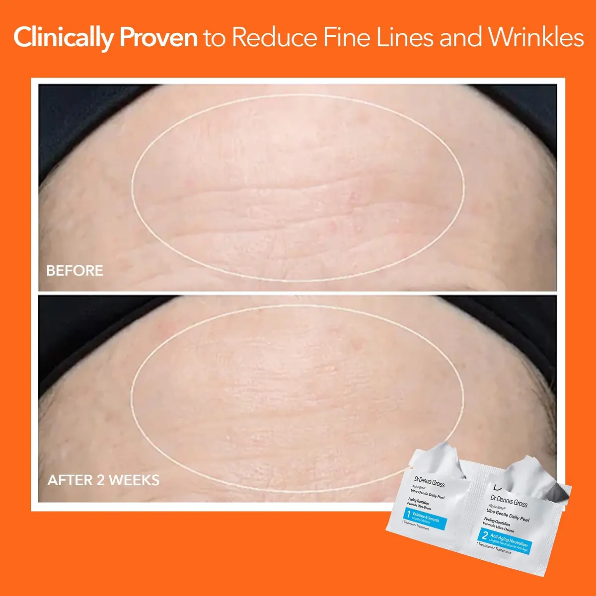 Dr Dennis Gross Alpha Beta Ultra Gentle Exfoliating Daily Peel - 5 Pack | Dermatologist-Formulated for Sensitive Skin - view 6