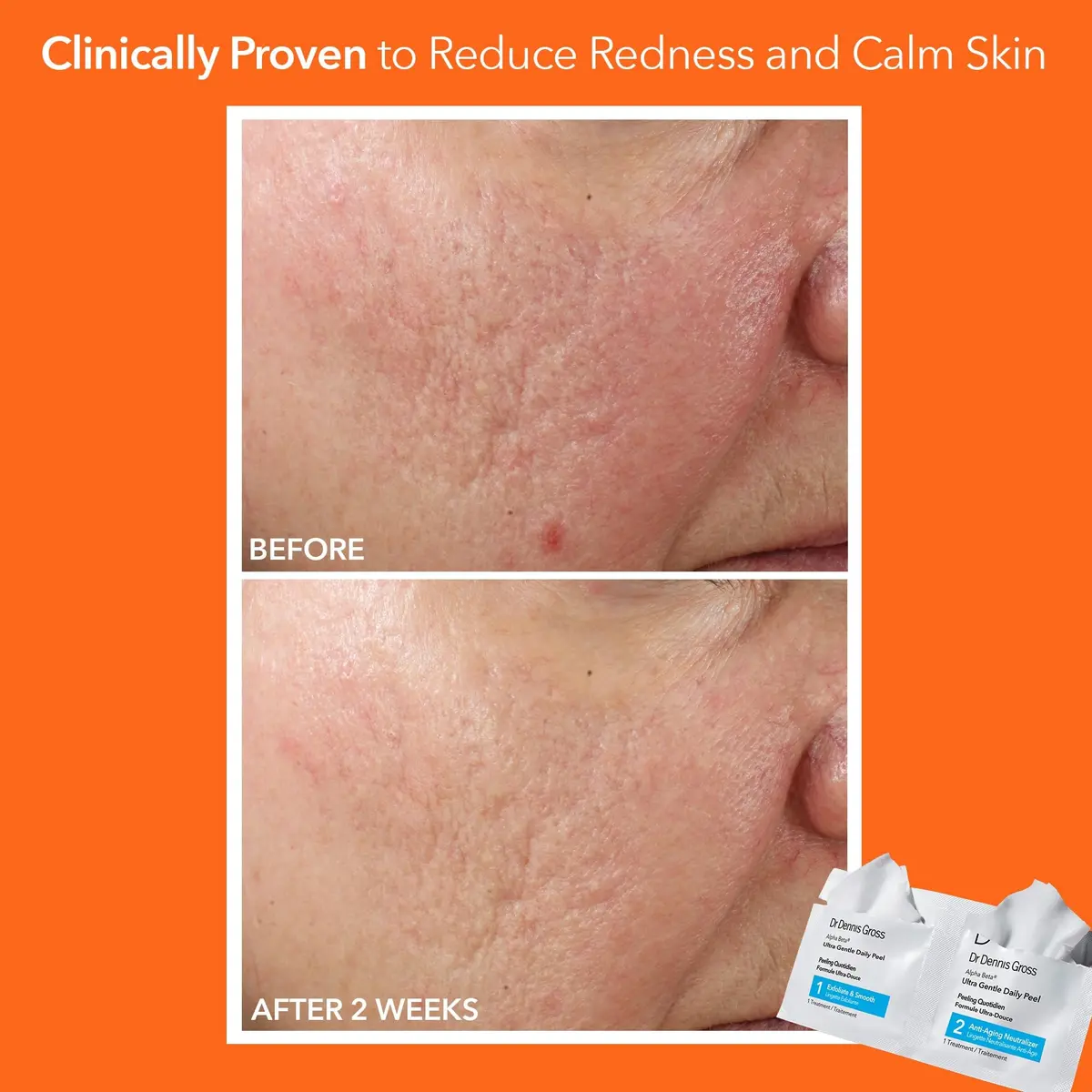 Dr Dennis Gross Alpha Beta Ultra Gentle Exfoliating Daily Peel - 5 Pack | Dermatologist-Formulated for Sensitive Skin - view 4