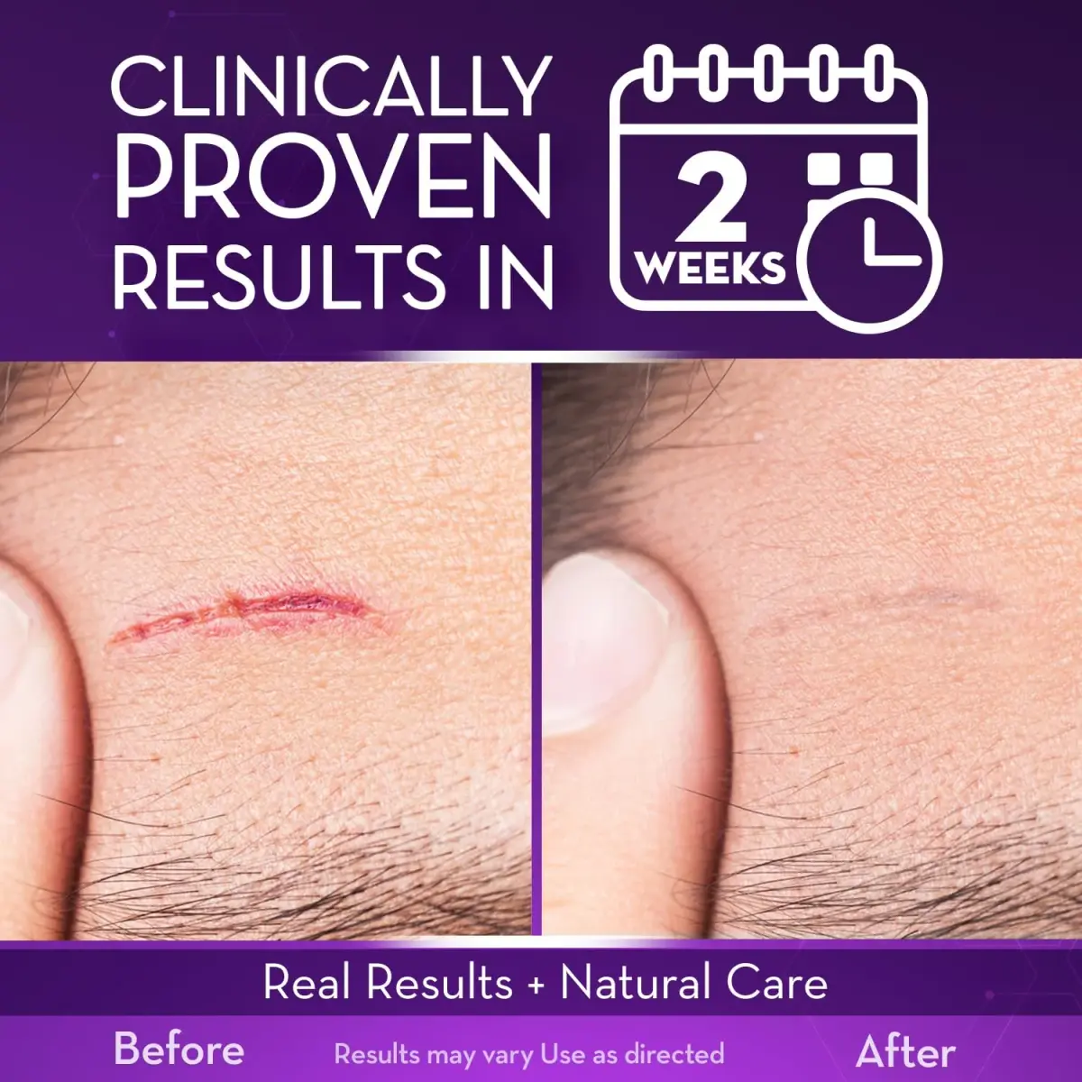 Cicatricure Advanced Scar Gel 28g (1 oz) 2pk | Clinically Proven Results in 2 Weeks - view 3