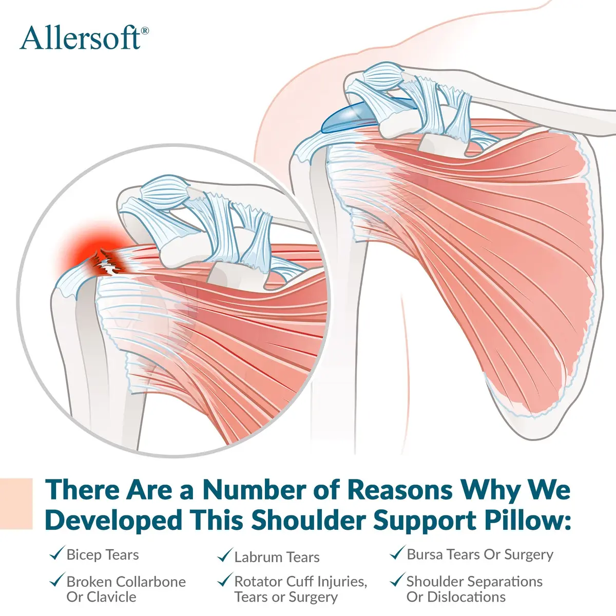 Allersoft Allercool SPJ Pillow for Post Shoulder Surgery Recovery | 33cm (13" L x 4" H x 14" W) - view 8