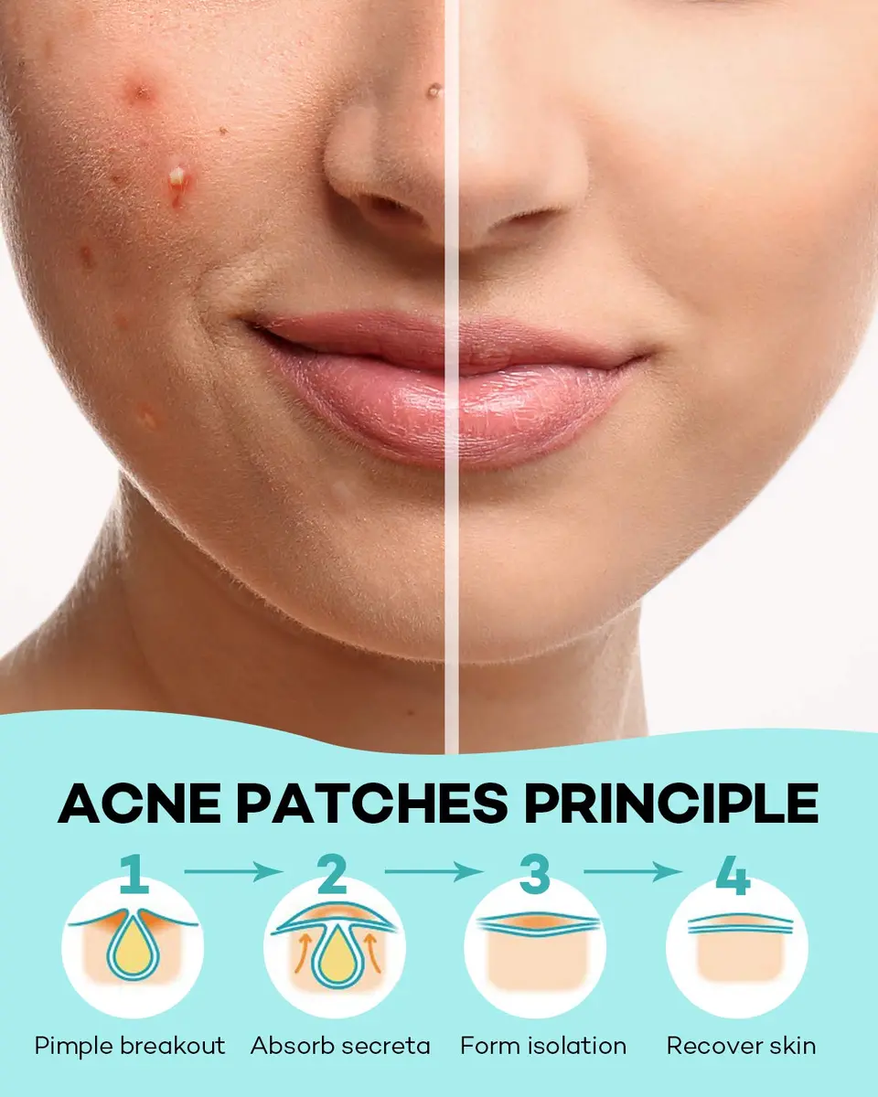 TKTK Acne Patch Hydrocolloid Cover 4 Sizes | Tea Tree & Calendula for All Skin Types - view 6