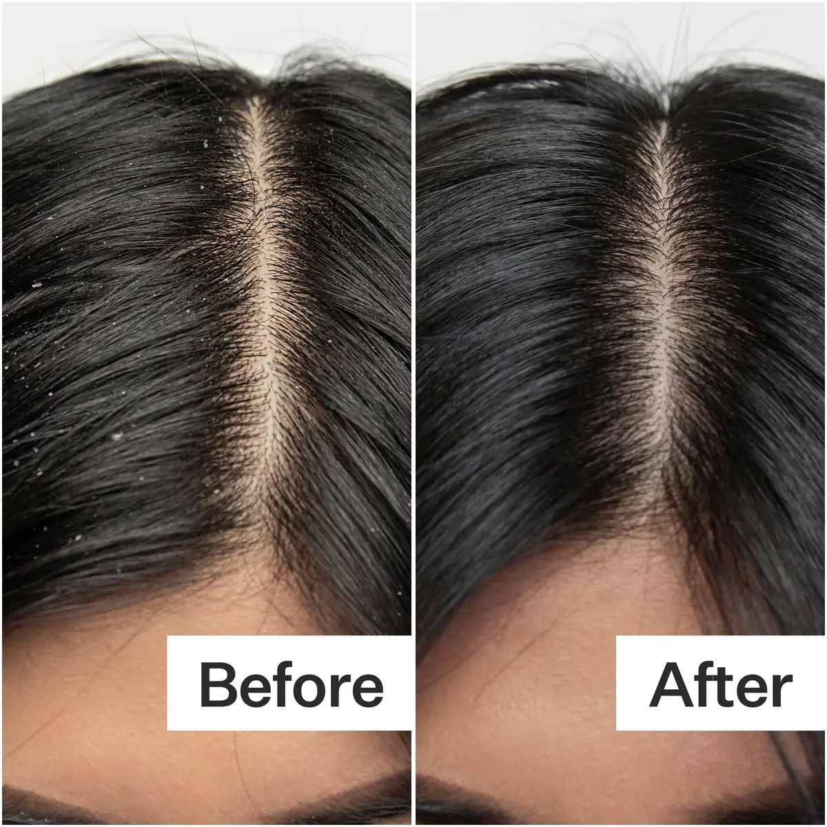 ACT+ ACRE Salicylic Acid Scalp Exfoliator 2 fl oz | Gentle Oil & Flake Removal for Oily Scalp - view 5