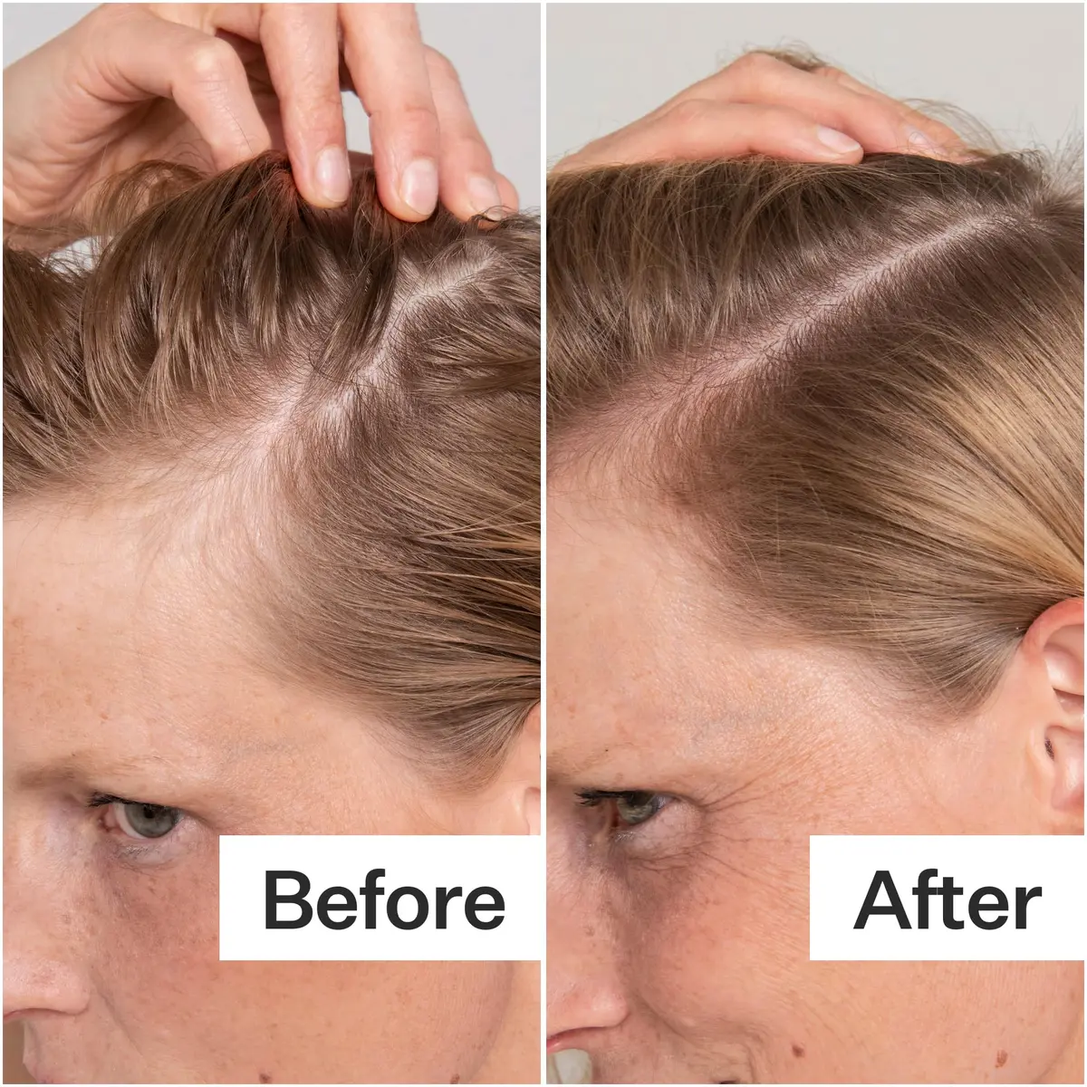 ACT+ ACRE Salicylic Acid Scalp Exfoliator 2 fl oz | Gentle Oil & Flake Removal for Oily Scalp - view 3