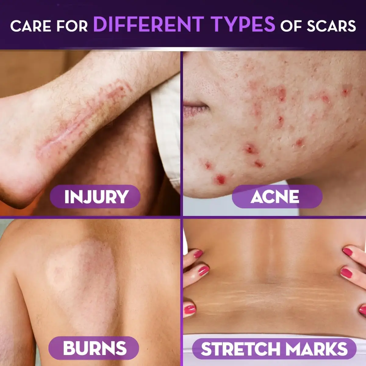 Cicatricure Advanced Scar Gel 28g (1 oz) 3-Pack | Clinically Proven Scar Reduction - view 4