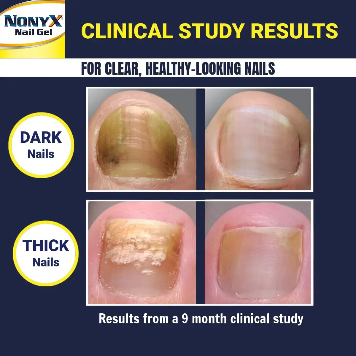 NONYX Fungal Nail Clarifying Gel (8 Fl Oz / 237ml) | Clinically Proven for Discolored, Thick, Brittle, Yellow, Lifted Nails - view 4