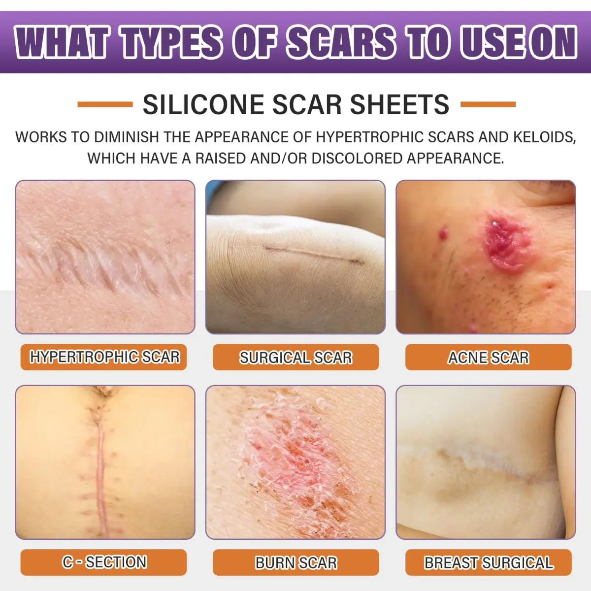 PSECICI Silicone Scar Sheets 3M (1.6" x 120") | Medical Grade Scar Tape for All Scar Types - view 2