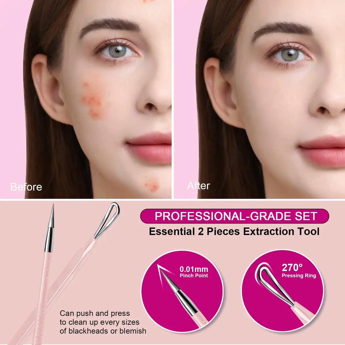 Teenitor Blackhead & Blemish Remover Kit | 2-in-1 Stainless Steel Tools for Face, Pink - view 6