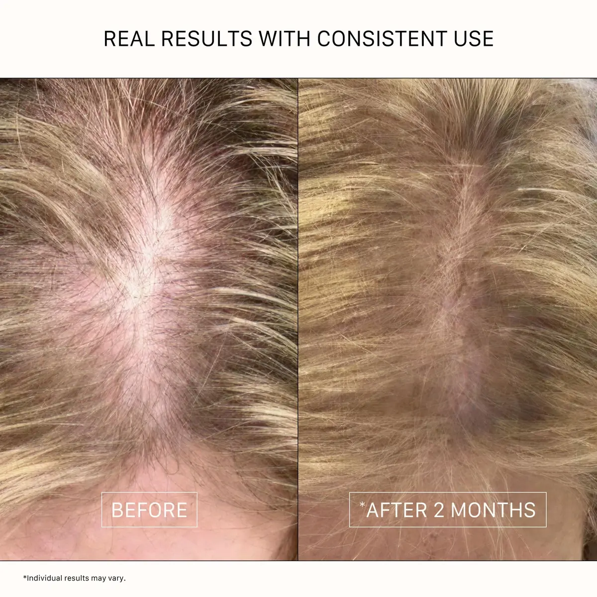ACTIIV Recover Travel Duo for Women | Fuller Hair in 90 Days (5.4 Fl Oz) - view 6