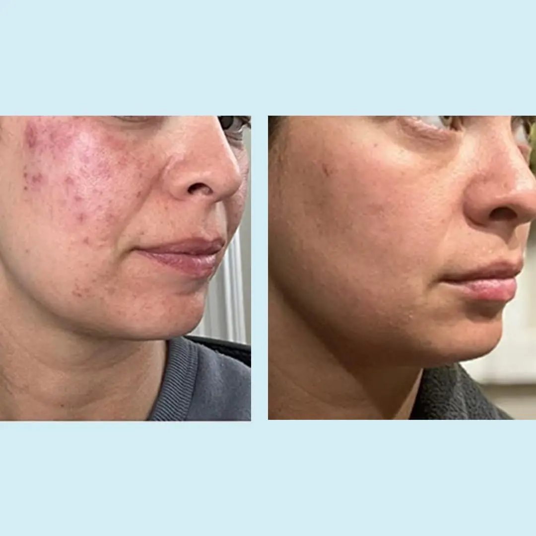 Perfect Image Glycolic Gel Peel 70% Strength for Experienced Users, 1 Fl Oz | High-Concentration Face Exfoliant - view 5